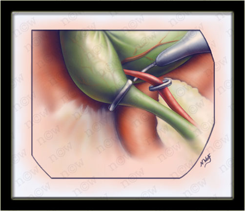 Laparoscopic Cholecystectomy Step 2 (Nicole Wolf)