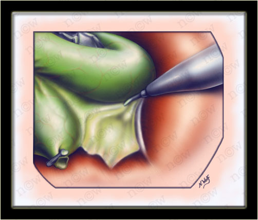 Laparoscopic Cholecystectomy Step 6 (Nicole Wolf)