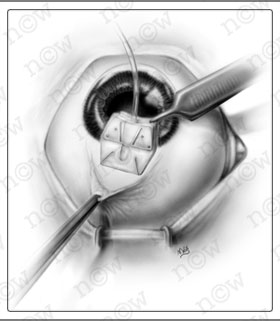 Glaucoma Shunt Placement (Nicole Wolf)