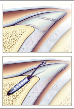 Hip Labrum Histology Detail Nicole Wolf