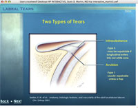 Labral Tears Hip Arthroscopy Interactive